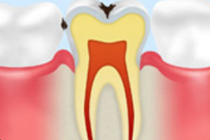 エナメル質のむし歯