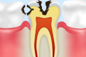 象牙質のむし歯