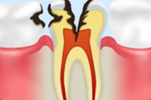 神経まで達したむし歯