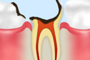 歯根まで達したむし歯