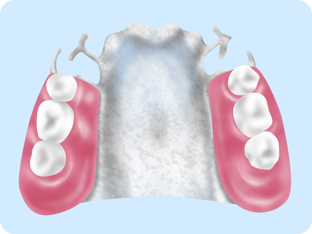 金属床義歯（チタン・コバルトクロム）