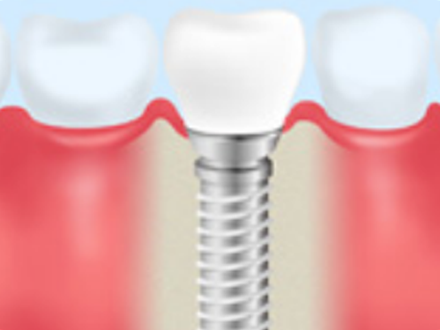 インプラント