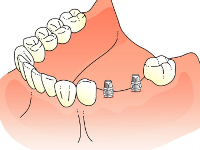 手術2回目～人工歯の土台連結