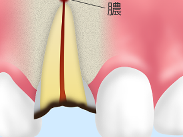歯根端切除術