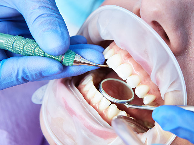 歯の揺度の検査
