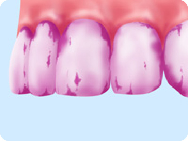 プラーク（歯垢）の染め出し